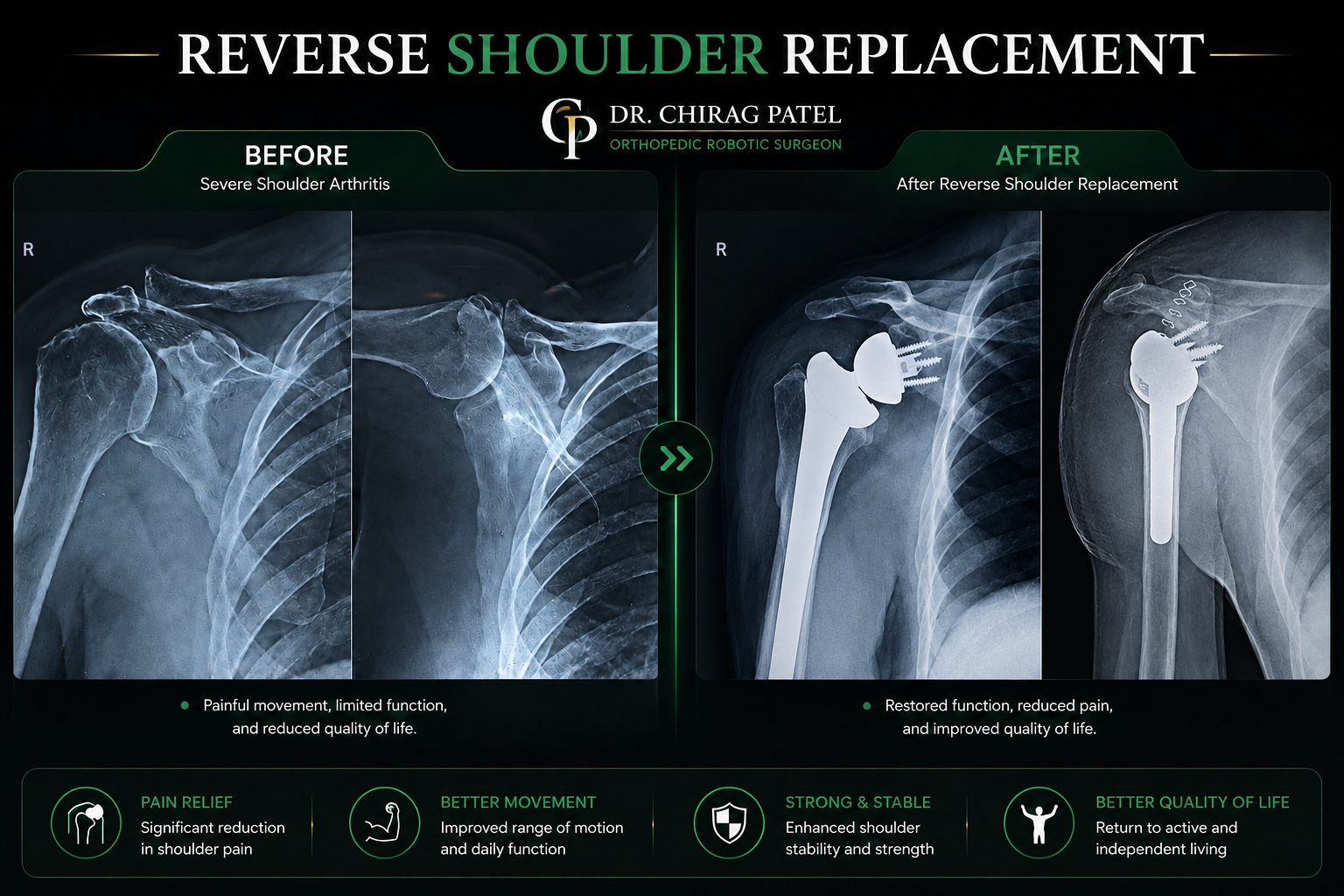 Reverse Shoulder Replacement